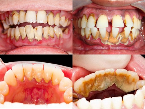 9 Cách làm trắng răng bị ố vàng tại nhà CHỈ SAU 5 PHÚT