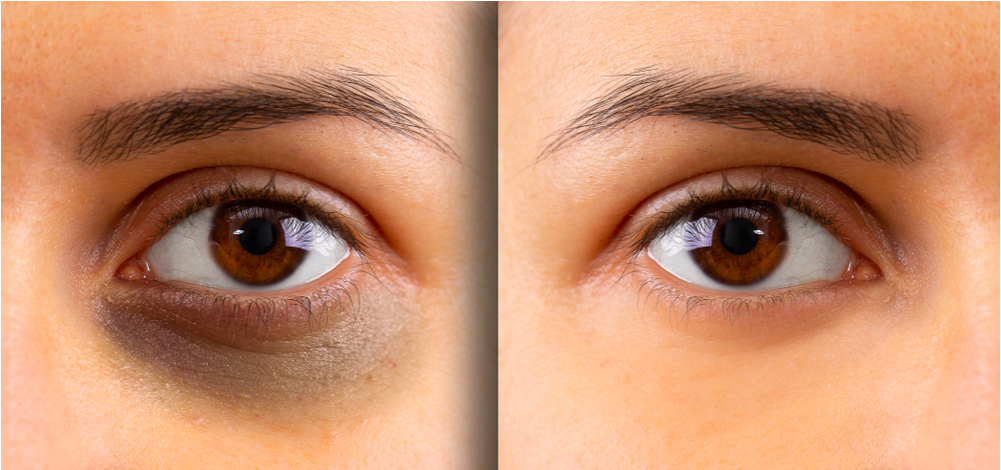 20 cách làm hết thâm quầng mắt sau 1 đêm cực hiệu quả New