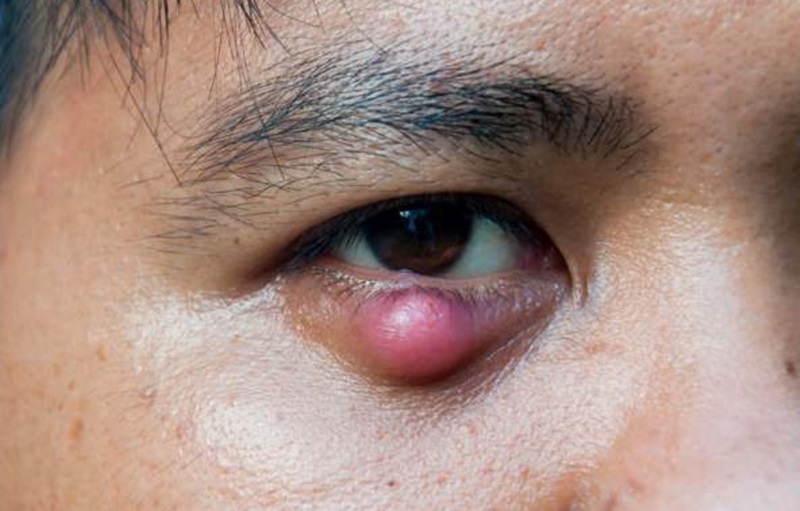 [ REVIEW ] 7+ cách chữa mụn lẹo ở mắt đảm bảo hiệu quả và an toàn